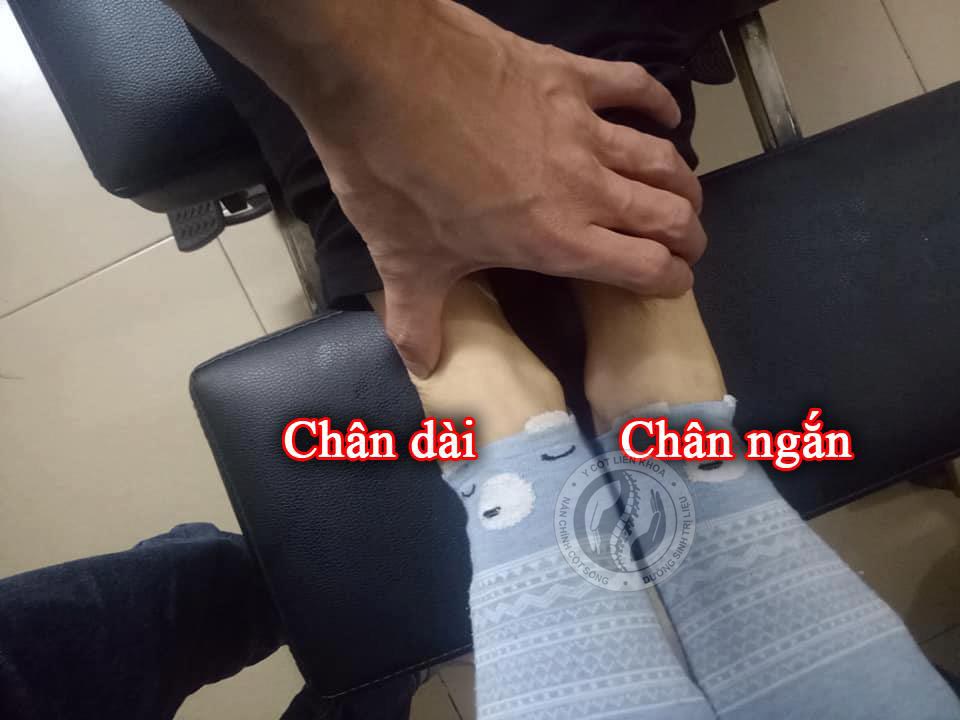 lệch xương chậu bàn chân dài bàn chân ngắn