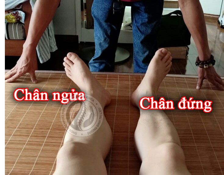 lệch xương chậu bàn chân đứng bàn chân ngửa