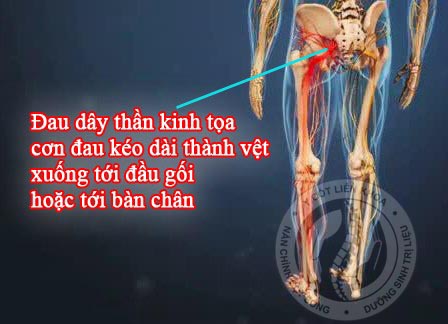 lệch xương chậu đau thần kinh tọa