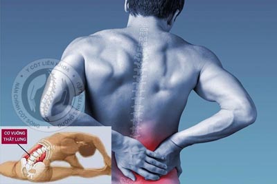 nắn chỉnh cột sống điều trị cơ vuông thắt lưng